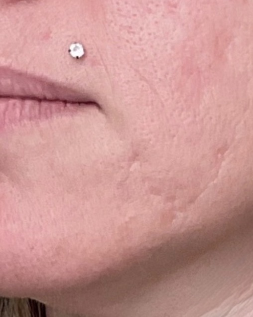 Lip filler result, before treatment
